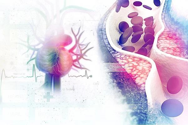Blutgefäß mit Arteriosklerose, Gefäßverschluss, Illustration
