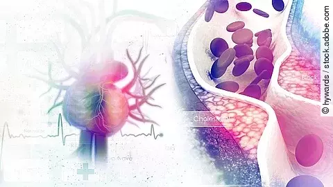 Blutgefäß mit Arteriosklerose, Gefäßverschluss, Illustration
