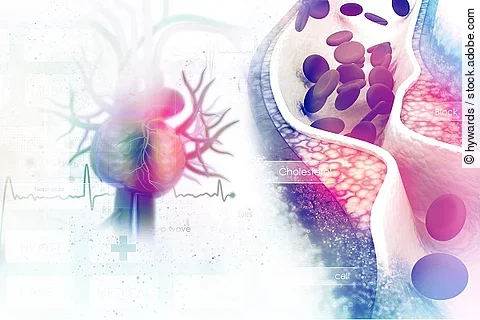 Blutgefäß mit Arteriosklerose, Gefäßverschluss, Illustration