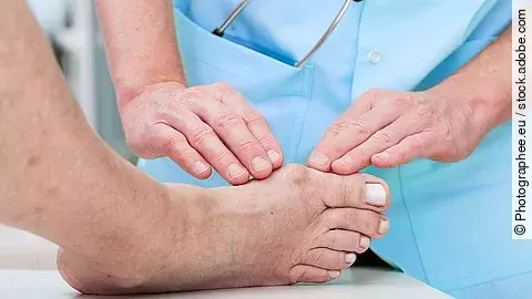 Arzthände untersuchen einen Fuß mit Hallux valgus