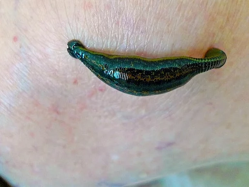 Blutegeltherapie bei Gonarthrose