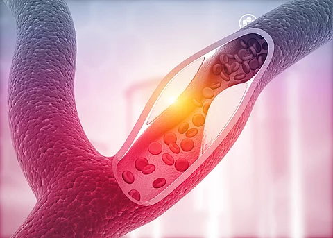 Illustration: Blutgefäß mit atherosklerotischen Ablagerungenosklerose 