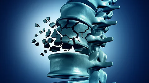 Illustration: Eine Wirbelsäule mit gesunden Wirbeln, dazwischen ein Wirbel, der zerfällt.