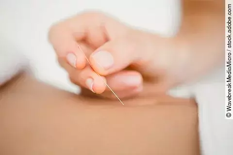 Akupunktur im Bauchbereich, Hand setzt Nadel