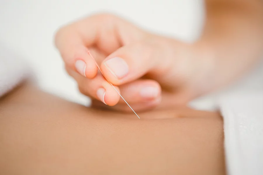 Woman holding a needle in an acupuncture therapy Akupunktur im Bauchbereich, Hand setzt Nadel