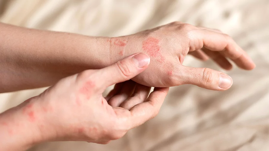 entzündete Haut an den Händen einer Frau