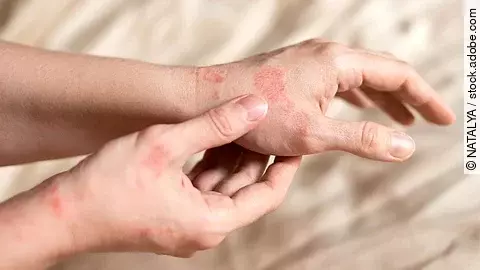 entzündete Haut an den Händen einer Frau