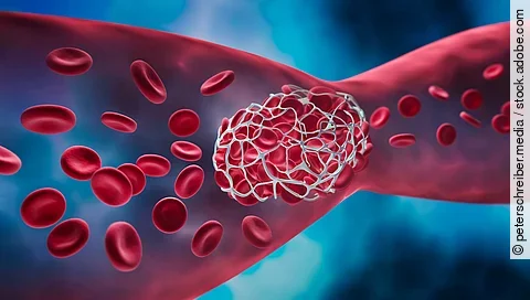 Illustration: Blutgefäß, das von einem Klumpen verschlossen wird