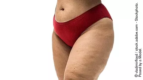Oberschenkel einer Frau mit Lipödem