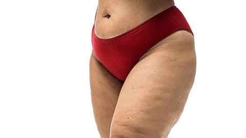 Oberschenkel einer Frau mit Lipödem