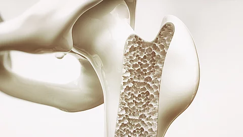 Illustration: osteoporotischer Oberschenkelknochen