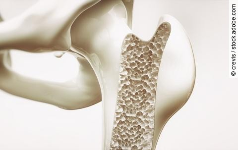 Illustration: osteoporotischer Oberschenkelknochen