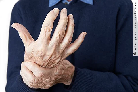 Nahaufnahme von arthritischen Händen.