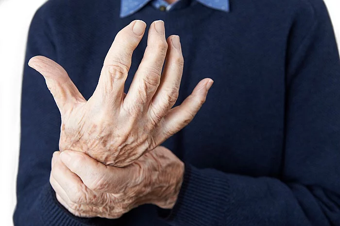 Nahaufnahme von arthritischen Händen.