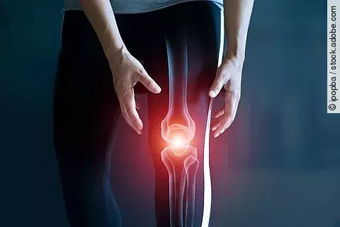 Frau mit Knieschmerz/Gelenkentzündung