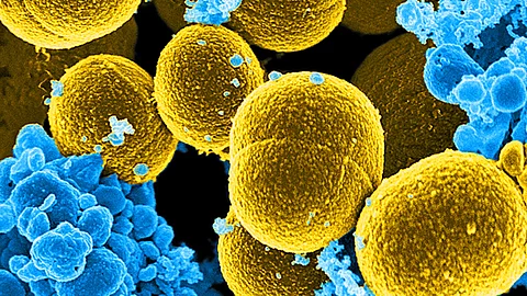 gefärbte rasterelektronenmikroskopische Aufnahme von senffarbenen kugelförmigen Staphylococcus aureus-Bakterien, umgeben von weißen Blutkörperchen