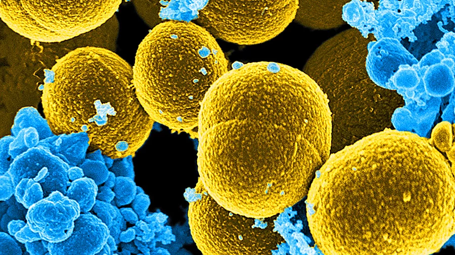 gefärbte rasterelektronenmikroskopische Aufnahme von senffarbenen kugelförmigen Staphylococcus aureus-Bakterien, umgeben von weißen Blutkörperchen