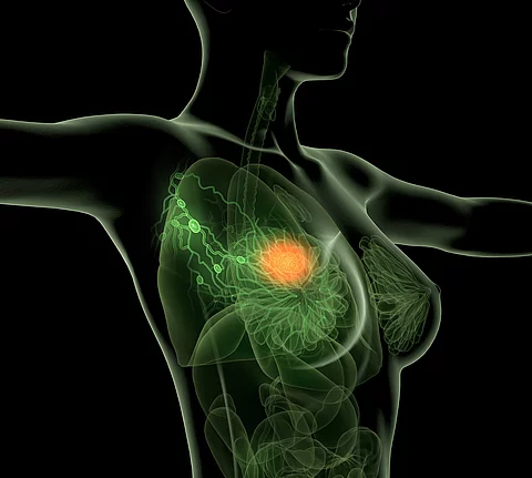 Medizinische Illustration: Tumor in der Brust orange eingefärbt