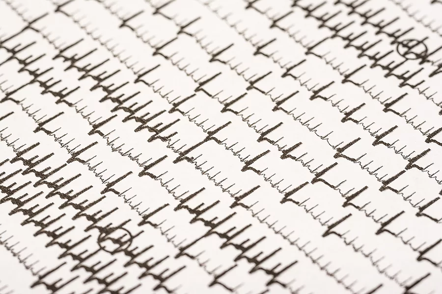 Extrasystoles And Atrial Fibrillation On Electrocardiogram Elektrokardiogramm