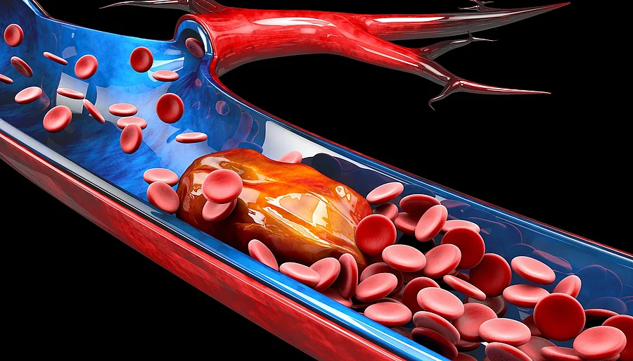 3d Illustration of Deep Vein Thrombosis or Blood Clots. Embolism 3D Illustration von Blutzellen in Vene