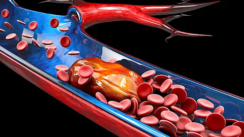 3d Illustration of Deep Vein Thrombosis or Blood Clots. Embolism 3D Illustration von Blutzellen in Vene