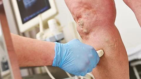 Ein Phlebologe führt eine Ultraschalluntersuchung der Venen eines Patienten mit Krampfadern durch. 