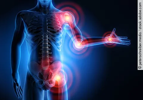 Eine schematische Darstellung des Körpers mit rot markierten Rheuma-Schmerzpunkten an verschiedenen Gelenken. 