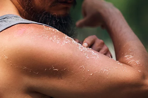 Oberarm eines Mannes, die Haut schält sich nach Sonnenbrand