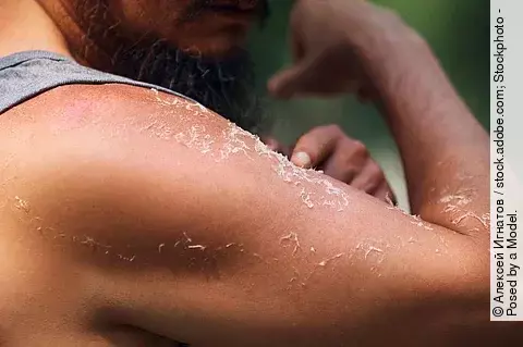 Oberarm eines Mannes, die Haut schält sich nach Sonnenbrand