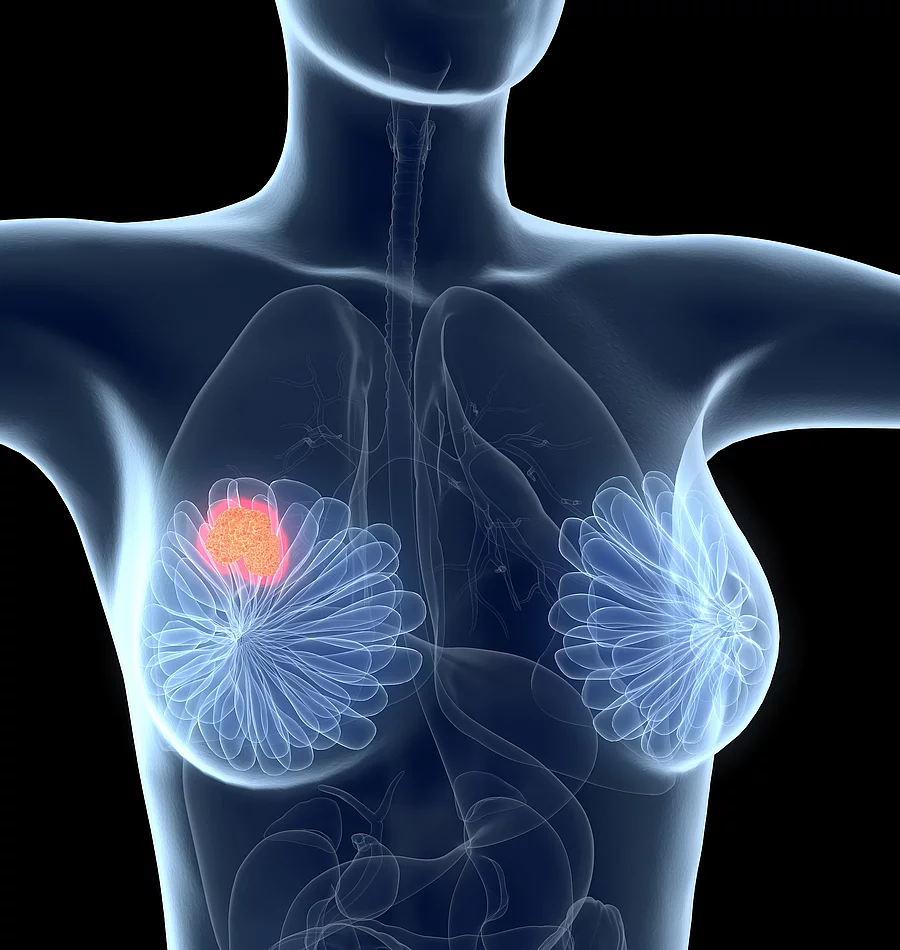 Brustkrebs 3D Animation eines Brust-Tumors