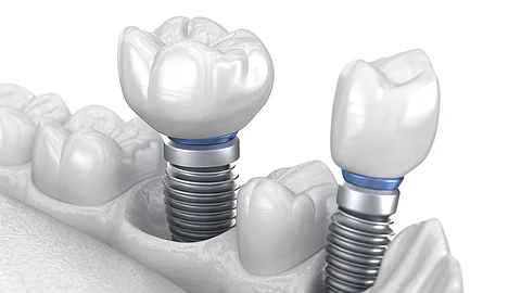 3D-Illustration: Zahnreihe mit 2 Implantaten und Krone