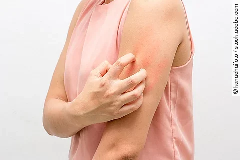 Frau kratzt sich mit der Hand am Oberarm