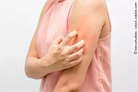 Frau kratzt sich mit der Hand am Oberarm