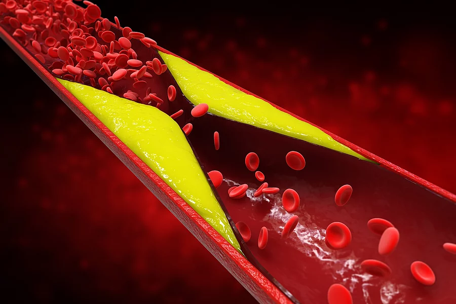 Illustration: atherosklerotisches Plaque in einem Blutgefäß