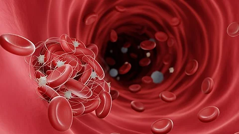 Blood clots (fibrin clots) are usually formed to stop the bleedi Blutgefäß mit Thrombus