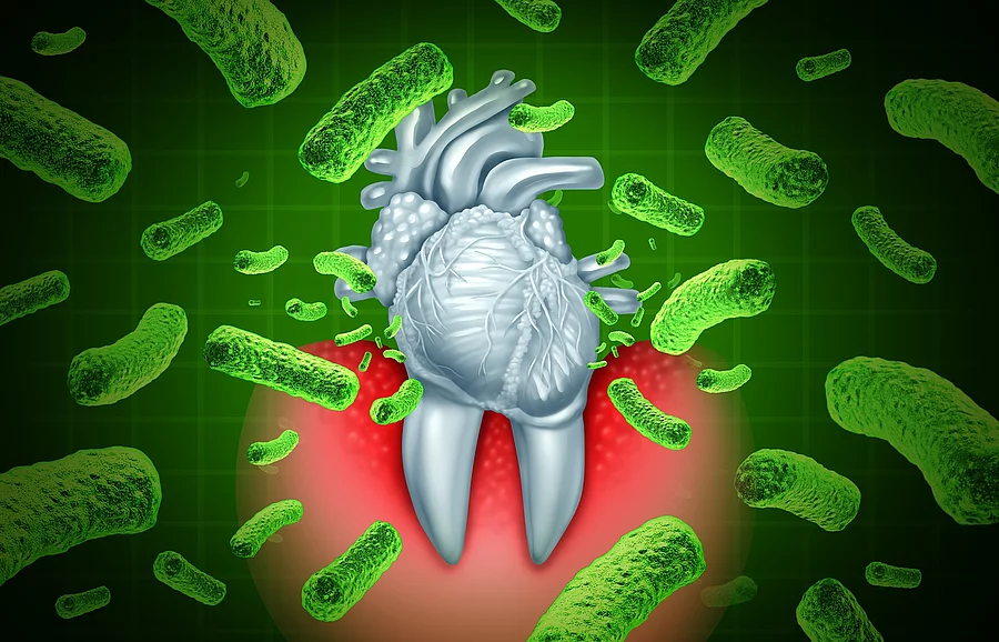 Illustration: Von Bakterien umgebener Zahn, im Zahnwurzelbereich entzündlich rot