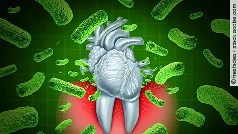 Illustration: Parodontitis