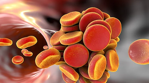 Medizinische Illustration: Thrombus in einem Blutgefäß