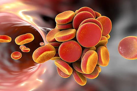 Medizinische Illustration: Thrombus in einem Blutgefäß