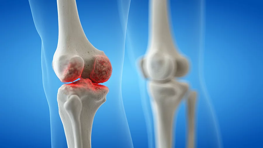 3d rendered medically accurate illustration of an arthritic knee joint Illustration: gesundes Kniegelenk neben geschädigtem Kniegelenk vor blauem Hintergrund