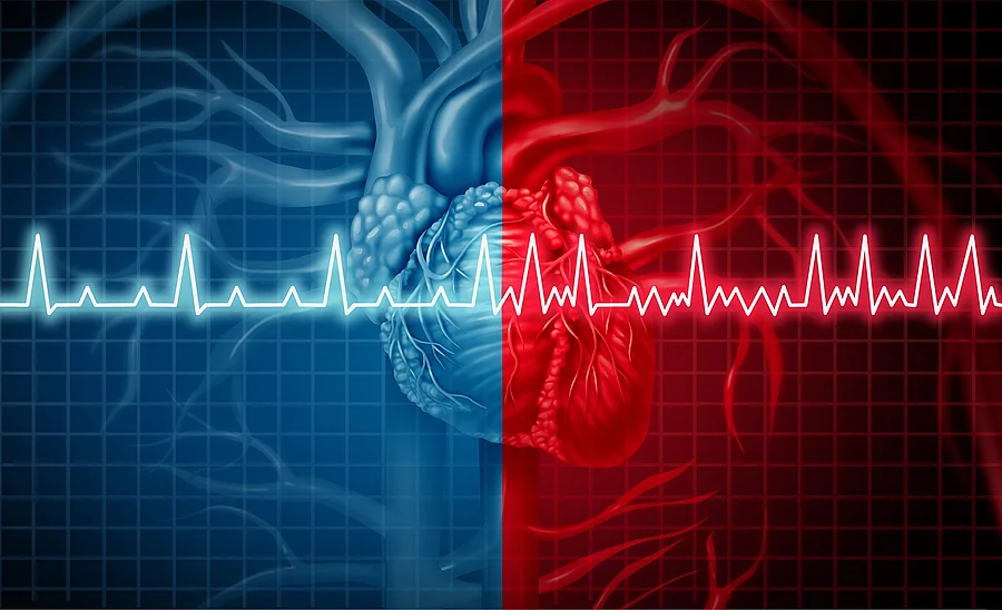 Illustration: Herzrhythmusstörungen, Herz und darüberliegend EKG-Kurve