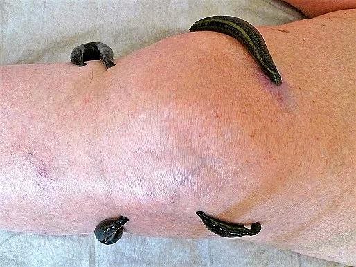 Blutegeltherapie bei Gonarthrose