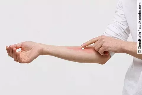 Allergische Reaktion auf der Haut, die mit einer Salbe behandelt wird.