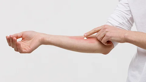 Allergische Reaktion auf der Haut, die mit einer Salbe behandelt wird.