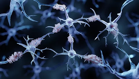 Amyloid-Plaques bei Alzheimer