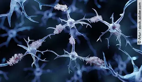 Amyloid-Plaques bei Alzheimer