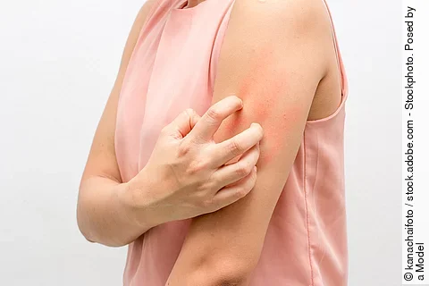 Frau kratzt sich am Arm, Haut ist gerötet