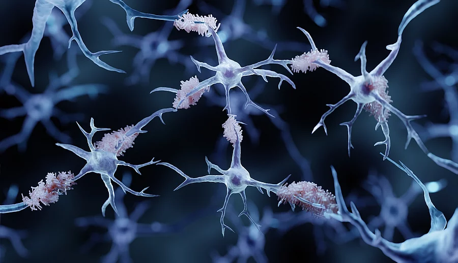 Illustration: Amyloid-Plaques im Gehirn bei Alzheimer