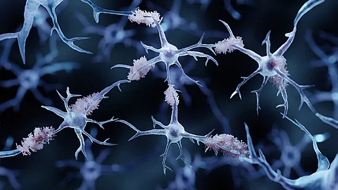 Illustration: Amyloid-Plaques im Gehirn bei Alzheimer