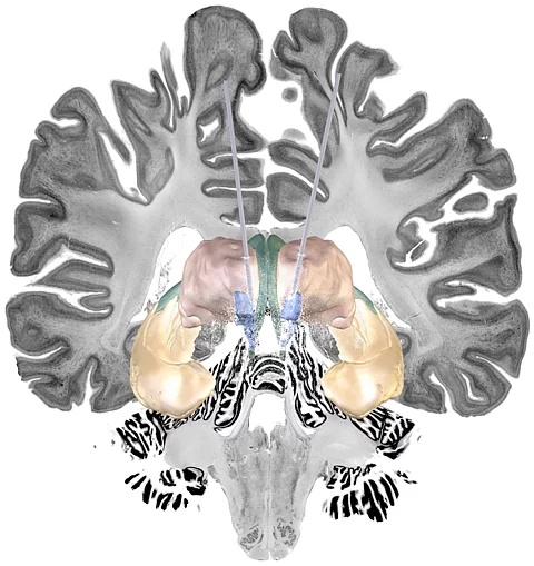 Illustration: Hirnstimulation bei Alzheimer